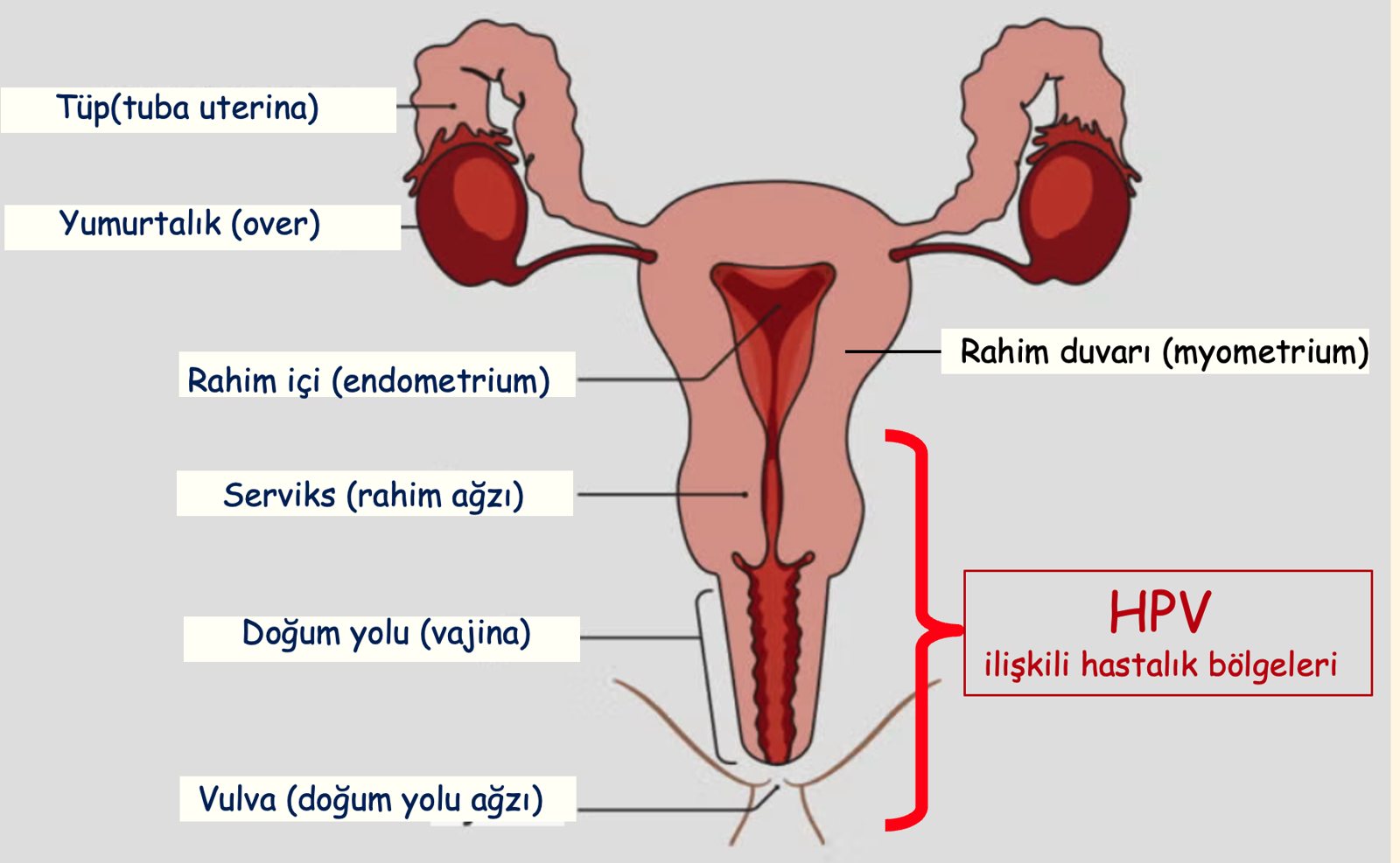 HPV ile ilişkili hastalıkların görülebildiği bölgeleri gösteren kadın üreme organları şeması