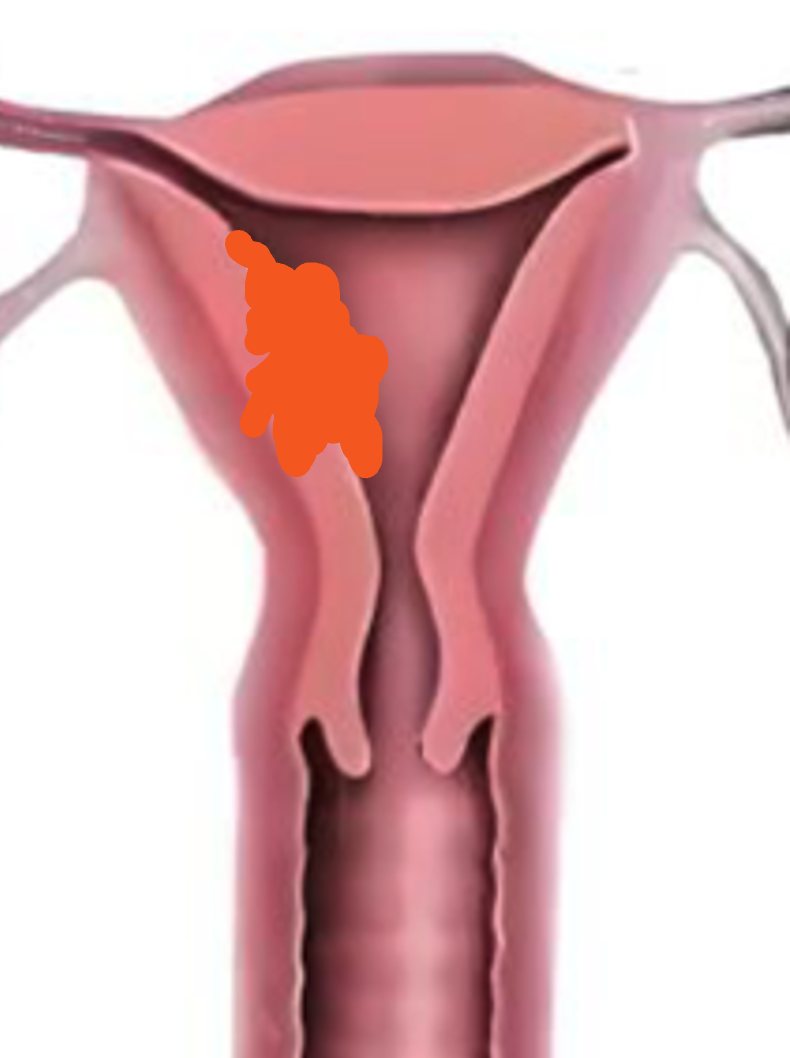 Rahim içi (endometrium) tabakasında yerleşen tümörü gösteren şema