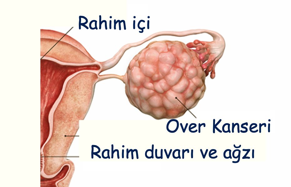 Yumurtalıkta (over) gelişen kitleyi ve rahim ile ilişkisini gösteren şema